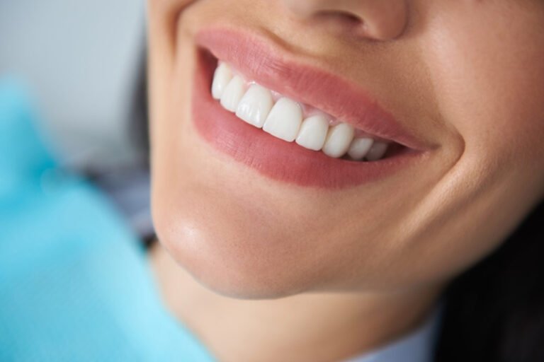 Is Composite Bonding Newcastle Right for Chipped or Uneven Teeth